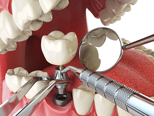 Best Emergency Wisdom Teeth Removal in Broadway, NC